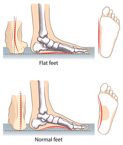 thongs for flat feet